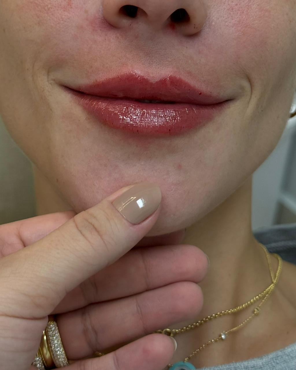 Resultado de Preenchimento Labial 1