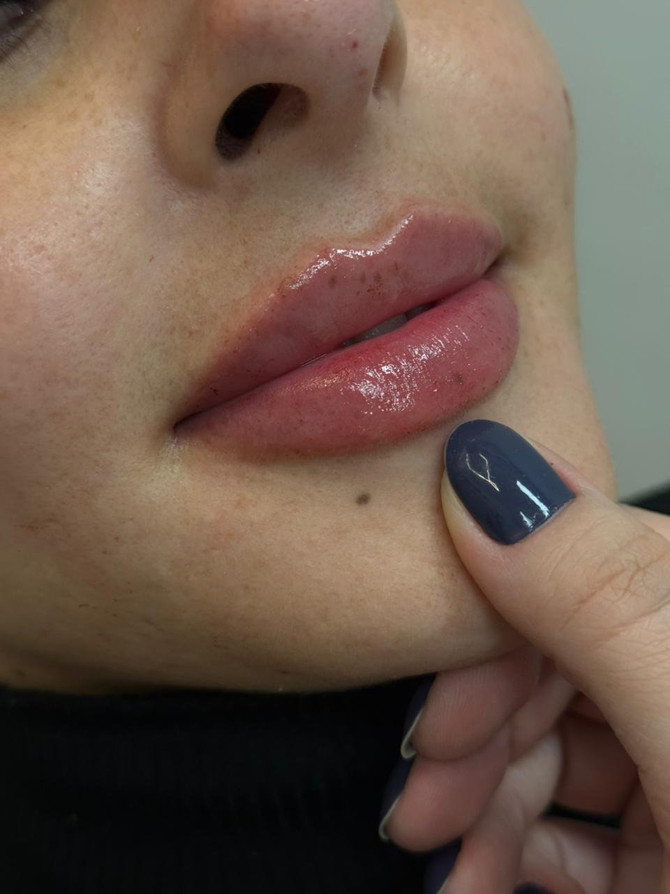 Resultado de Preenchimento Labial 2