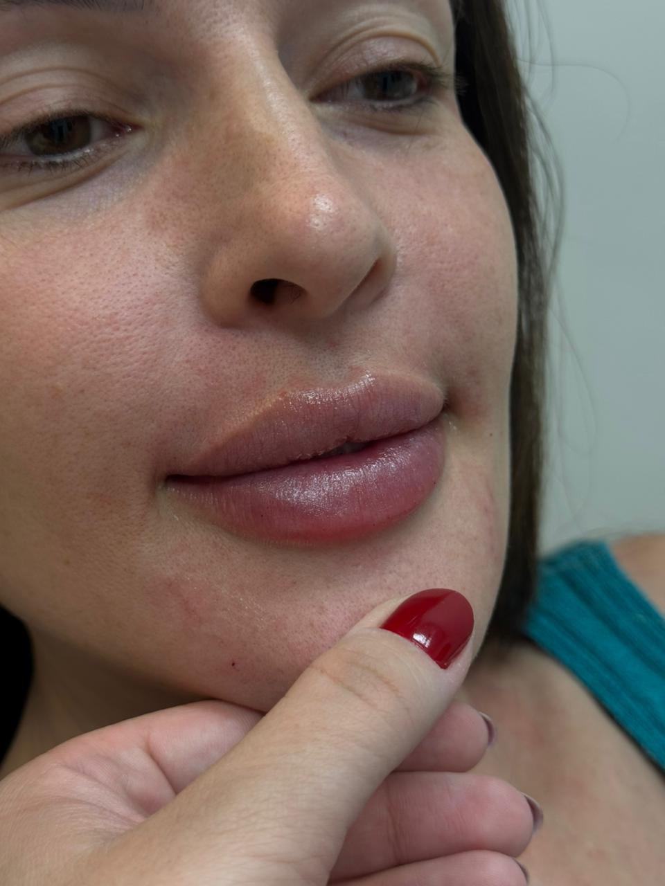 Resultado de Preenchimento Labial 3