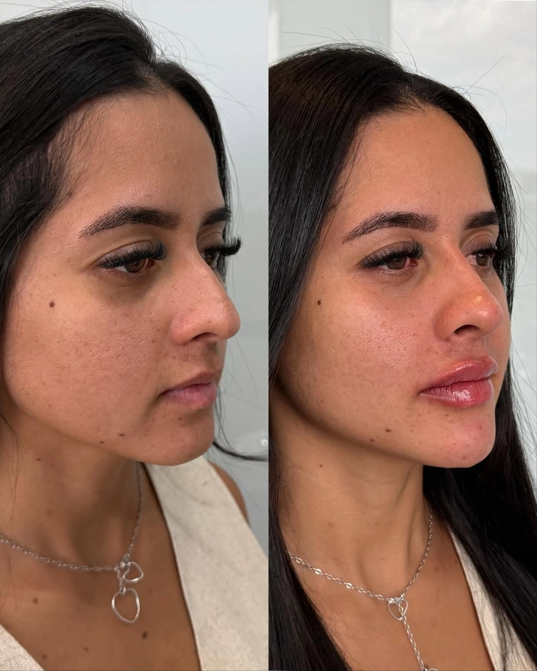Resultado Antes e Depois de Harmonização de Perfil e Lábios