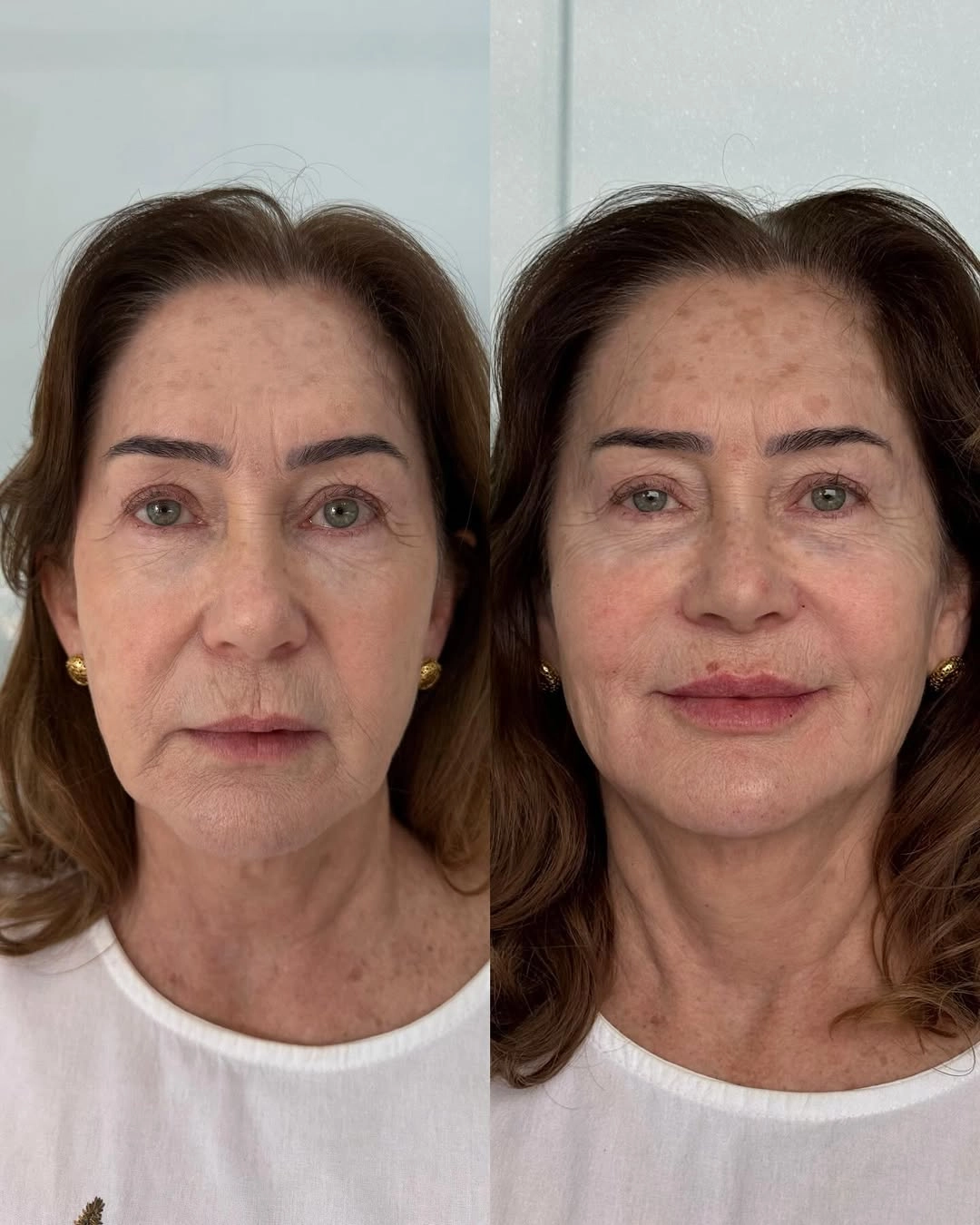 Resultado de harmonização facial Full Face